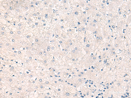 Immunohistochemistry of paraffin-embedded Human liver cancer tissue  using CEBPB  Polyclonal Antibody at dilution of 1:30(×200)