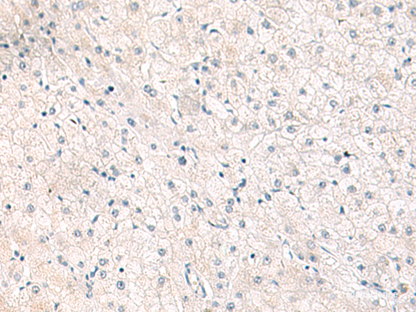 Immunohistochemistry of paraffin-embedded Human liver cancer tissue  using FGFR4 Polyclonal Antibody at dilution of 1:25(×200)
