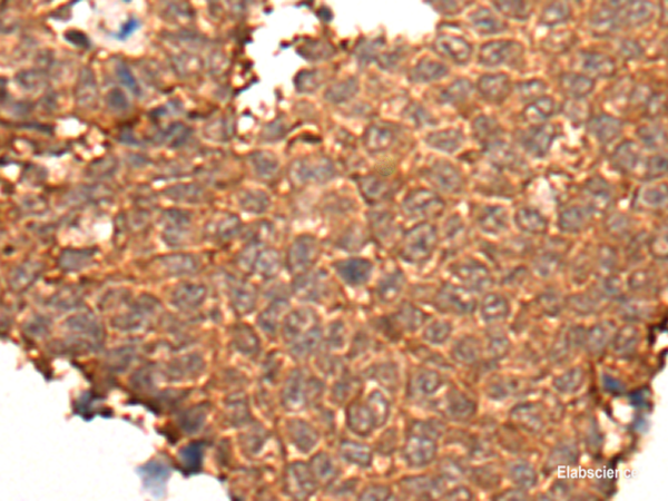 Immunohistochemistry of paraffin-embedded Human ovarian cancer tissue  using HOXD8 Polyclonal Antibody at dilution of 1:40(×200)