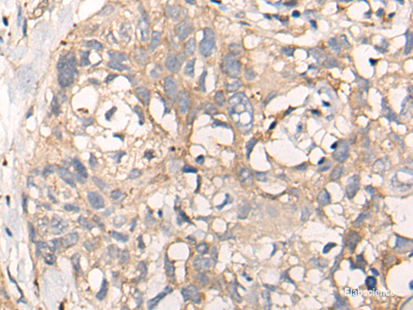Immunohistochemistry of paraffin-embedded Human lung cancer tissue  using NREP Polyclonal Antibody at dilution of 1:35(×200)