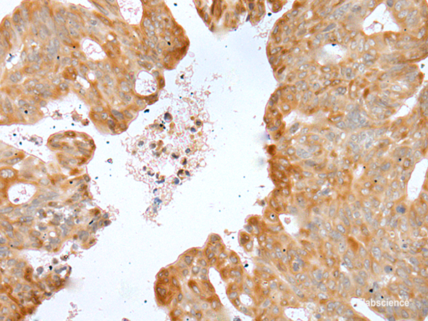 Immunohistochemistry of paraffin-embedded Human gastric cancer tissue  using P2RY4 Polyclonal Antibody at dilution of 1:40(×200)