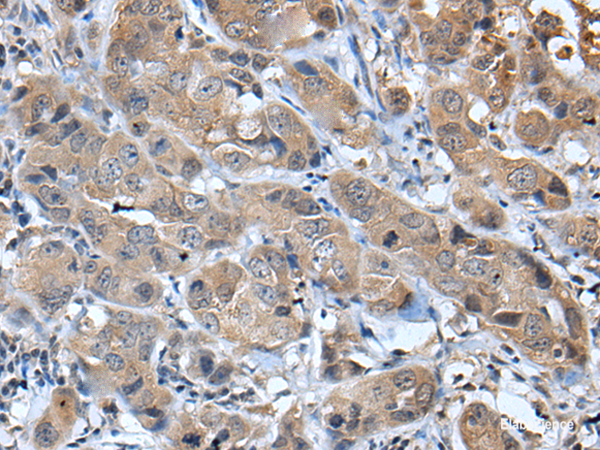 Immunohistochemistry of paraffin-embedded Human breast cancer tissue  using CXCL5 Polyclonal Antibody at dilution of 1:45(×200)
