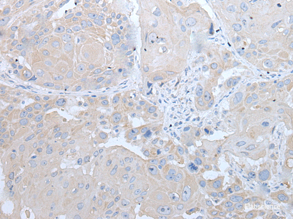 Immunohistochemistry of paraffin-embedded Human esophagus cancer tissue  using IFNB1 Polyclonal Antibody at dilution of 1:45(×200)