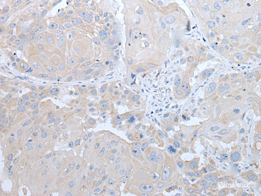 Immunohistochemistry of paraffin-embedded Human esophagus cancer tissue  using IFNB1 Polyclonal Antibody at dilution of 1:45(×200)