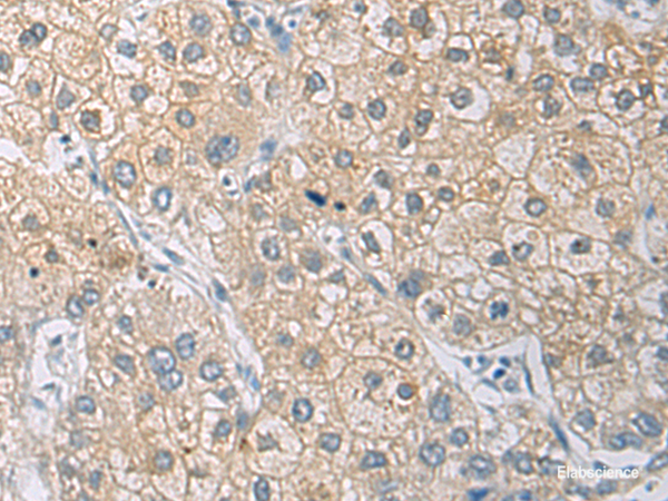 Immunohistochemistry of paraffin-embedded Human liver cancer tissue  using IL1RN Polyclonal Antibody at dilution of 1:50(×200)
