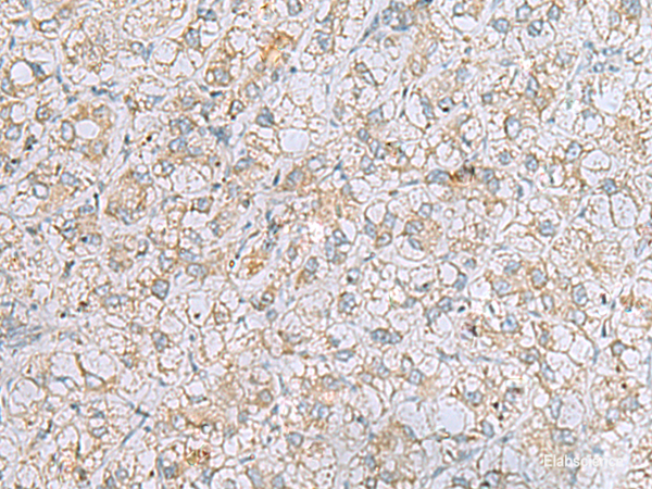Immunohistochemistry of paraffin-embedded Human liver cancer tissue  using LRRC49 Polyclonal Antibody at dilution of 1:40(×200)