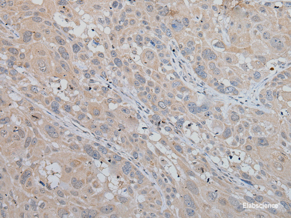 Immunohistochemistry of paraffin-embedded Human esophagus cancer tissue  using MLANA Polyclonal Antibody at dilution of 1:50(×200)