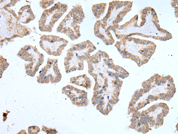 Immunohistochemistry of paraffin-embedded Human thyroid cancer tissue  using ABCD1 Polyclonal Antibody at dilution of 1:80(×200)