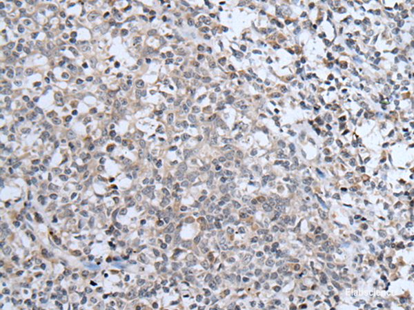 Immunohistochemistry of paraffin-embedded Human tonsil tissue  using ABCA6 Polyclonal Antibody at dilution of 1:40(×200)