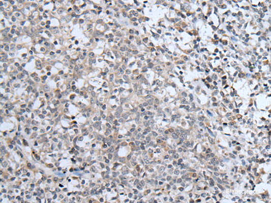 Immunohistochemistry of paraffin-embedded Human tonsil tissue  using ABCA6 Polyclonal Antibody at dilution of 1:40(×200)