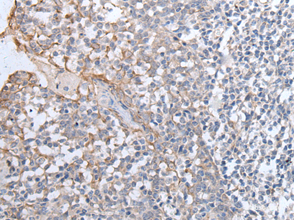 Immunohistochemistry of paraffin-embedded Human tonsil tissue  using GPD2 Polyclonal Antibody at dilution of 1:40(×200)