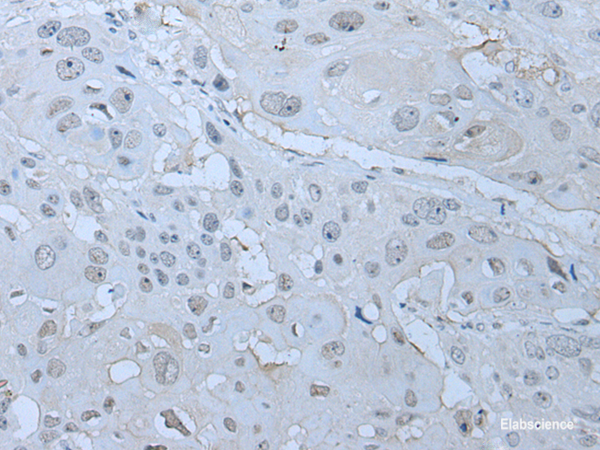 Immunohistochemistry of paraffin-embedded Human esophagus cancer tissue  using HUWE1 Polyclonal Antibody at dilution of 1:30(×200)