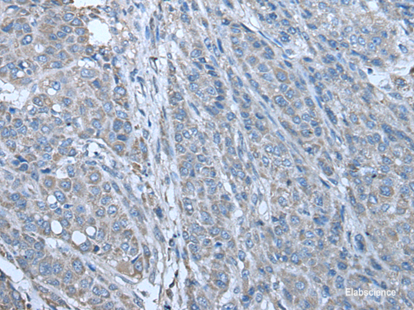 Immunohistochemistry of paraffin-embedded Human liver cancer tissue  using ZC3HAV1 Polyclonal Antibody at dilution of 1:70(×200)