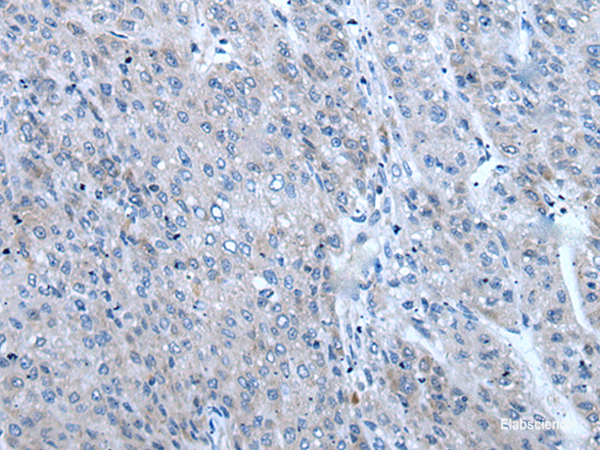 Immunohistochemistry of paraffin-embedded Human liver cancer tissue  using ZIC1 Polyclonal Antibody at dilution of 1:65(×200)
