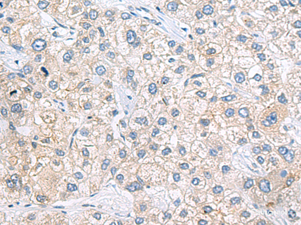 Immunohistochemistry of paraffin-embedded Human liver cancer tissue  using ZNF35 Polyclonal Antibody at dilution of 1:40(×200)