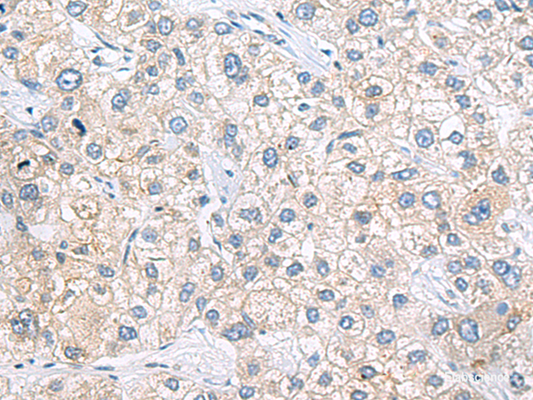 Immunohistochemistry of paraffin-embedded Human liver cancer tissue  using ZNF35 Polyclonal Antibody at dilution of 1:40(×200)