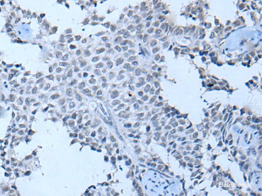 Immunohistochemistry of paraffin-embedded Human ovarian cancer tissue  using ZNF703 Polyclonal Antibody at dilution of 1:55(×200)