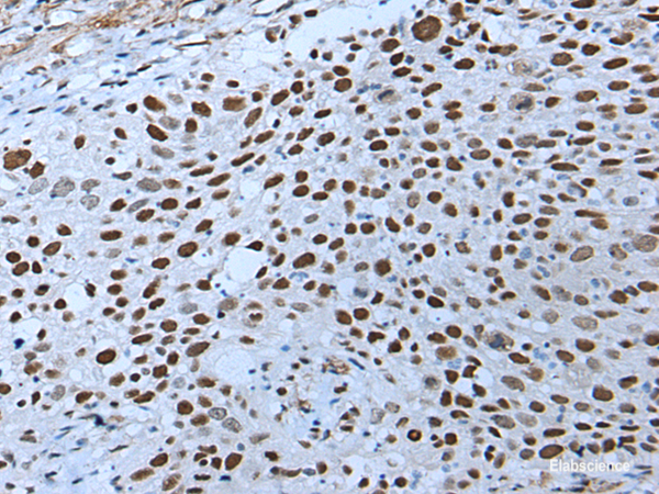 Immunohistochemistry of paraffin-embedded Human lung cancer tissue  using ZNHIT3 Polyclonal Antibody at dilution of 1:80(×200)