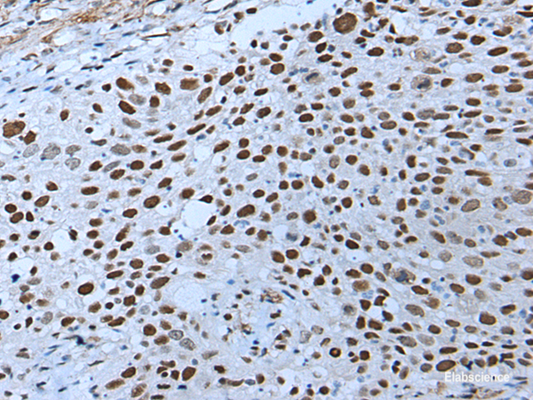 Immunohistochemistry of paraffin-embedded Human lung cancer tissue  using ZNHIT3 Polyclonal Antibody at dilution of 1:80(×200)