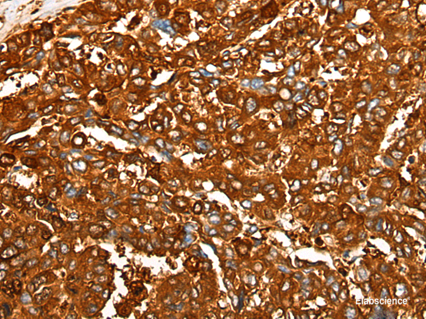 Immunohistochemistry of paraffin-embedded Human liver cancer tissue  using PEAR1 Polyclonal Antibody at dilution of 1:25(×200)