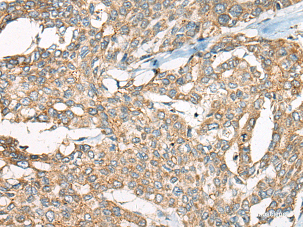 Immunohistochemistry of paraffin-embedded Human liver cancer tissue  using YEATS2 Polyclonal Antibody at dilution of 1:55(×200)
