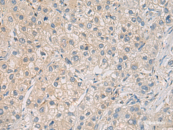 Immunohistochemistry of paraffin-embedded Human liver cancer tissue  using WFDC3 Polyclonal Antibody at dilution of 1:40(×200)