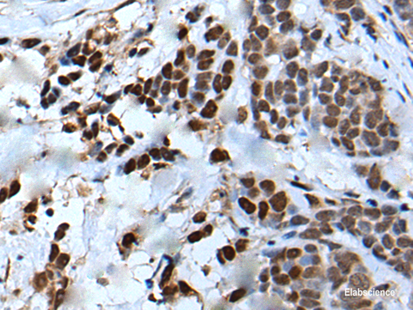 Immunohistochemistry of paraffin-embedded Human thyroid cancer tissue  using VEZT Polyclonal Antibody at dilution of 1:50(×200)