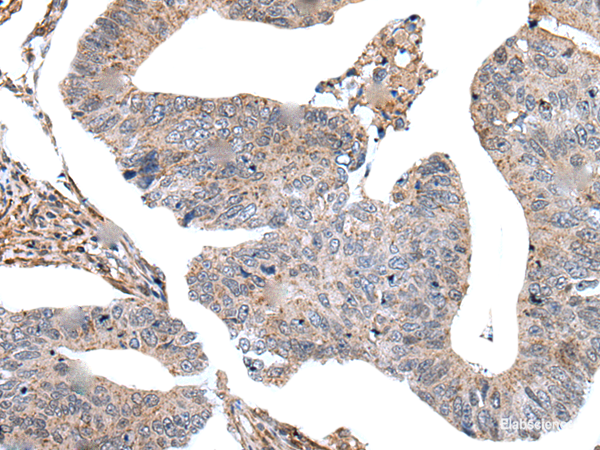 Immunohistochemistry of paraffin-embedded Human colorectal cancer tissue  using USP37 Polyclonal Antibody at dilution of 1:45(×200)