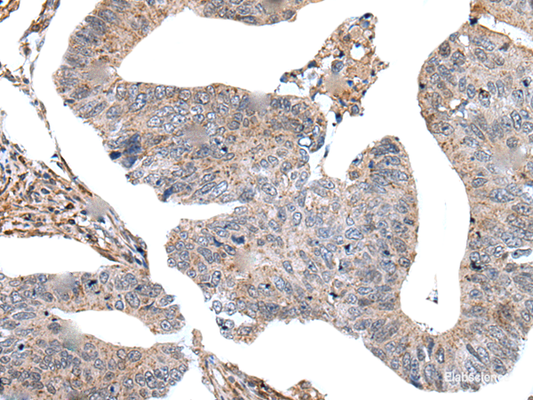Immunohistochemistry of paraffin-embedded Human colorectal cancer tissue  using USP37 Polyclonal Antibody at dilution of 1:45(×200)