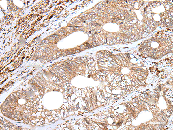 Immunohistochemistry of paraffin-embedded Human colorectal cancer tissue  using ENPEP Polyclonal Antibody at dilution of 1:65(×200)