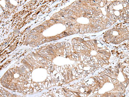 Immunohistochemistry of paraffin-embedded Human colorectal cancer tissue  using ENPEP Polyclonal Antibody at dilution of 1:65(×200)