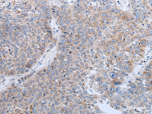 Immunohistochemistry of paraffin-embedded Human liver cancer tissue  using ENPP2 Polyclonal Antibody at dilution of 1:50(×200)