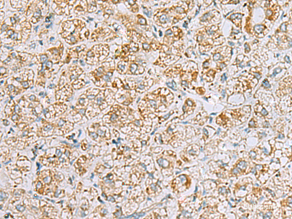Immunohistochemistry of paraffin-embedded Human liver cancer tissue  using INS(C-peptide) Polyclonal Antibody at dilution of 1:40(×200)