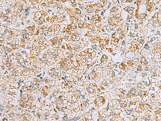 Immunohistochemistry of paraffin-embedded Human liver cancer tissue  using INS(C-peptide) Polyclonal Antibody at dilution of 1:40(×200)