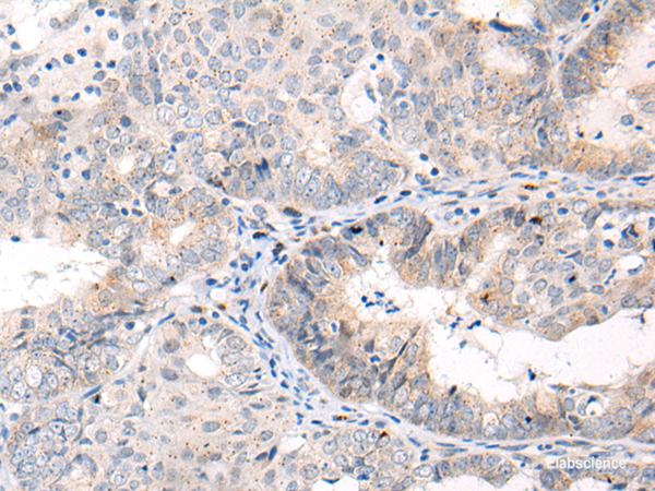 Immunohistochemistry of paraffin-embedded Human ovarian cancer tissue  using ANAPC15 Polyclonal Antibody at dilution of 1:70(×200)