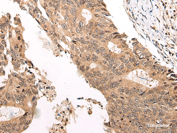 Immunohistochemistry of paraffin-embedded Human colorectal cancer tissue  using CHAMP1 Polyclonal Antibody at dilution of 1:40(×200)
