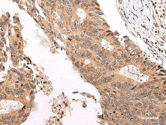 Immunohistochemistry of paraffin-embedded Human colorectal cancer tissue  using CHAMP1 Polyclonal Antibody at dilution of 1:40(×200)