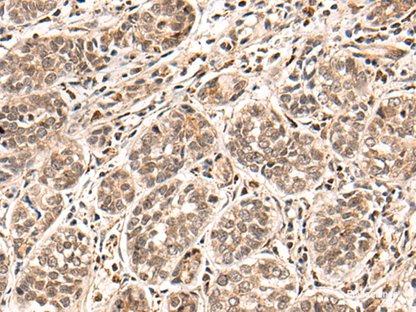 Immunohistochemistry of paraffin-embedded Human esophagus cancer tissue  using HGH1 Polyclonal Antibody at dilution of 1:45(×200)