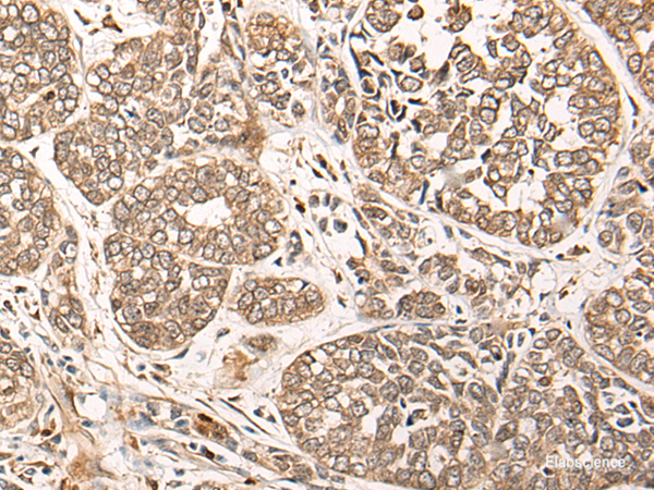 Immunohistochemistry of paraffin-embedded Human esophagus cancer tissue  using CA5B Polyclonal Antibody at dilution of 1:85(×200)
