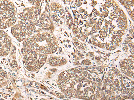 Immunohistochemistry of paraffin-embedded Human esophagus cancer tissue  using CA5B Polyclonal Antibody at dilution of 1:85(×200)