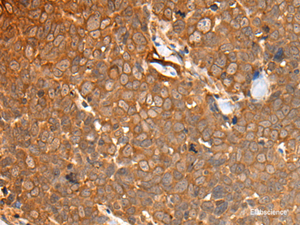 Immunohistochemistry of paraffin-embedded Human thyroid cancer tissue  using CAD Polyclonal Antibody at dilution of 1:50(×200)