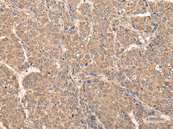 Immunohistochemistry of paraffin-embedded Human liver cancer tissue  using RCAN3 Polyclonal Antibody at dilution of 1:60(×200)