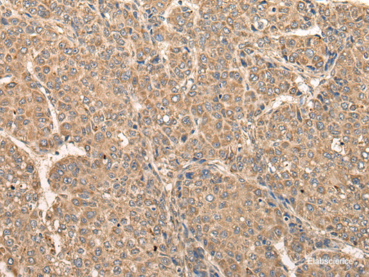 Immunohistochemistry of paraffin-embedded Human liver cancer tissue  using RCAN3 Polyclonal Antibody at dilution of 1:60(×200)