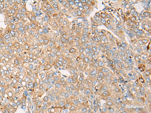 Immunohistochemistry of paraffin-embedded Human liver cancer tissue  using CAPN9 Polyclonal Antibody at dilution of 1:45(×200)