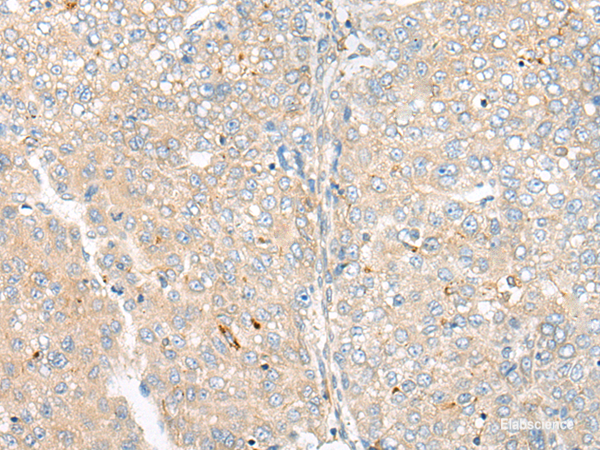 Immunohistochemistry of paraffin-embedded Human liver cancer tissue  using CAMK2A Polyclonal Antibody at dilution of 1:55(×200)