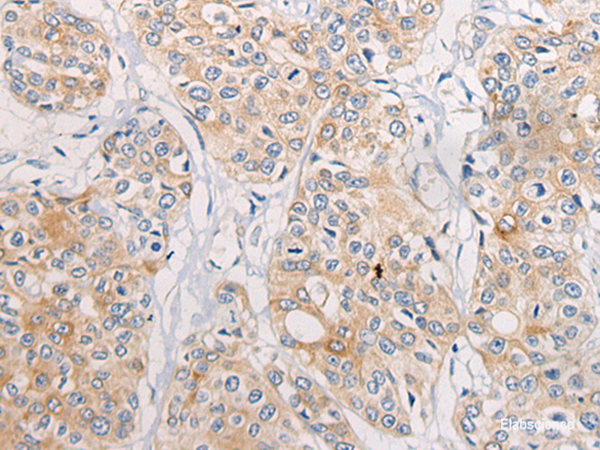 Immunohistochemistry of paraffin-embedded Human prost at e cancer tissue  using CPD Polyclonal Antibody at dilution of 1:70(×200)