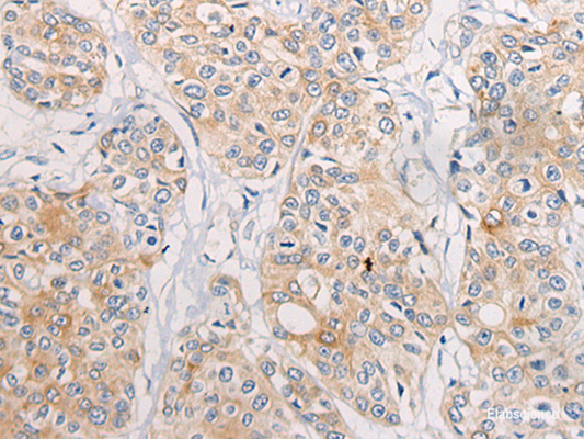 Immunohistochemistry of paraffin-embedded Human prost at e cancer tissue  using CPD Polyclonal Antibody at dilution of 1:70(×200)