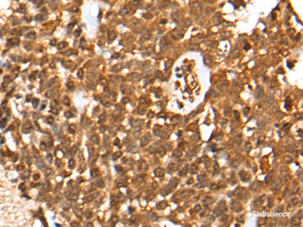 Immunohistochemistry of paraffin-embedded Human thyroid cancer tissue  using CASP8 Polyclonal Antibody at dilution of 1:35(×200)
