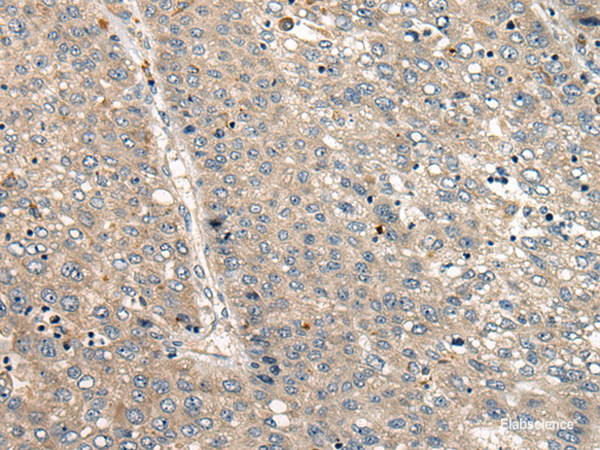 Immunohistochemistry of paraffin-embedded Human liver cancer tissue  using CC2D1A Polyclonal Antibody at dilution of 1:35(×200)