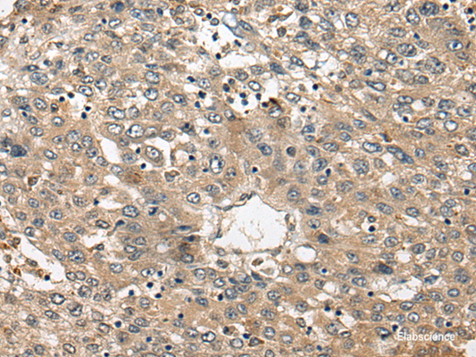 Immunohistochemistry of paraffin-embedded Human liver cancer tissue  using FUT4 Polyclonal Antibody at dilution of 1:40(×200)